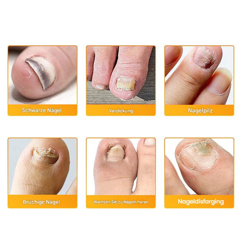 1+1 FREE | Nailox™ Plant-Based Formula That Penetrates Deep to Heal and Renew Nails