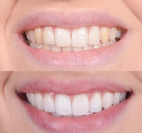 1+1 FREE | Brighten™ For A Radiant Smile That Lasts!