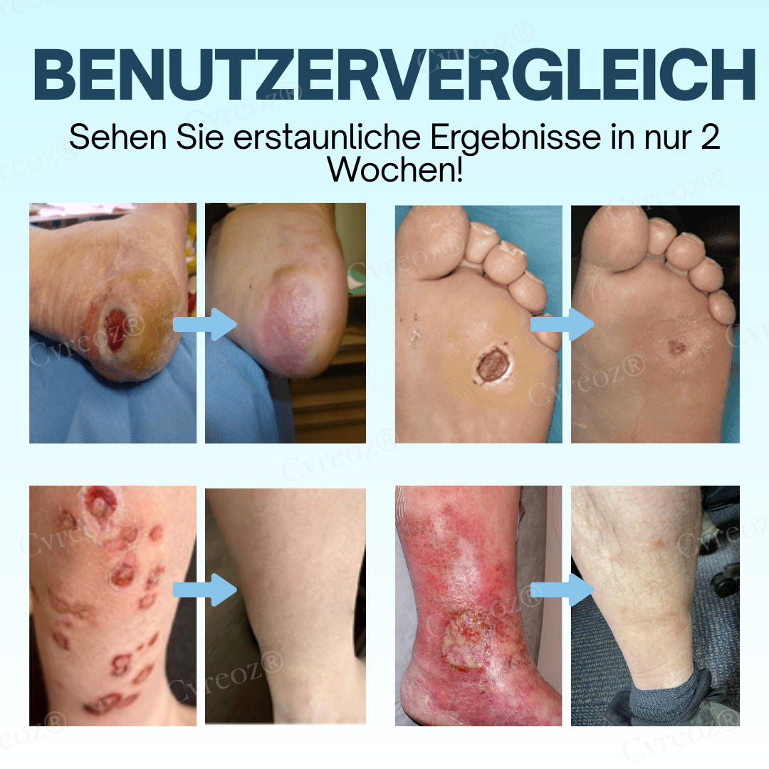 GlucoHeal™ – Moisturizes & Protects
