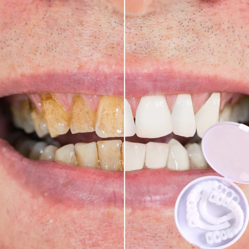 Snap-On™ - Always A Perfect Smile With These Veneers