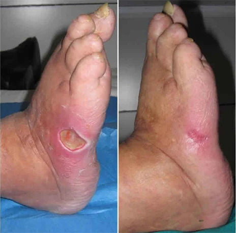 GlucoHeal™ – Moisturizes & Protects